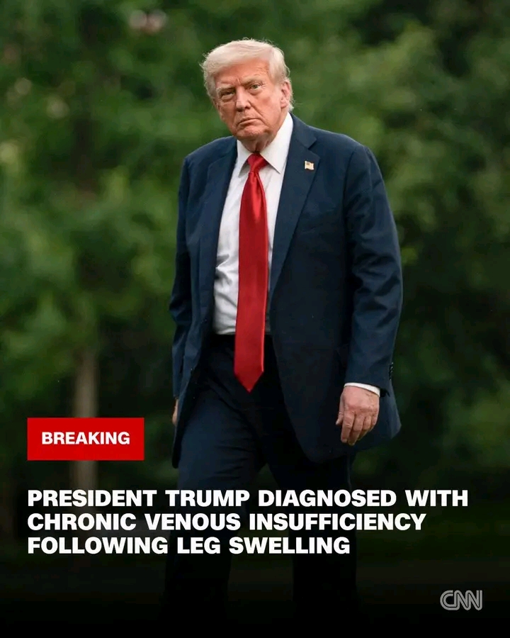BREAKING NEWS: White House doctors diagnosed Donald Trump with chronic venous insufficiency, though the physicians said the US president remained in “excellent health,” Press Secretary Karoline Leavitt said... See More